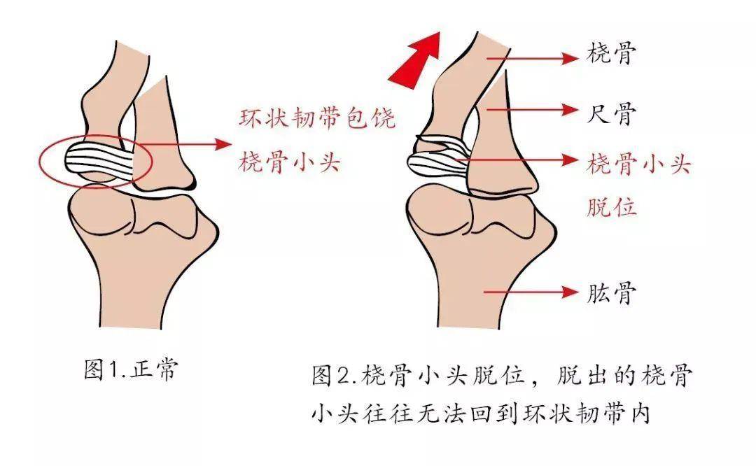 在床上翻腾时,身体将上肢压在身下,迫使肘枢纽过伸等