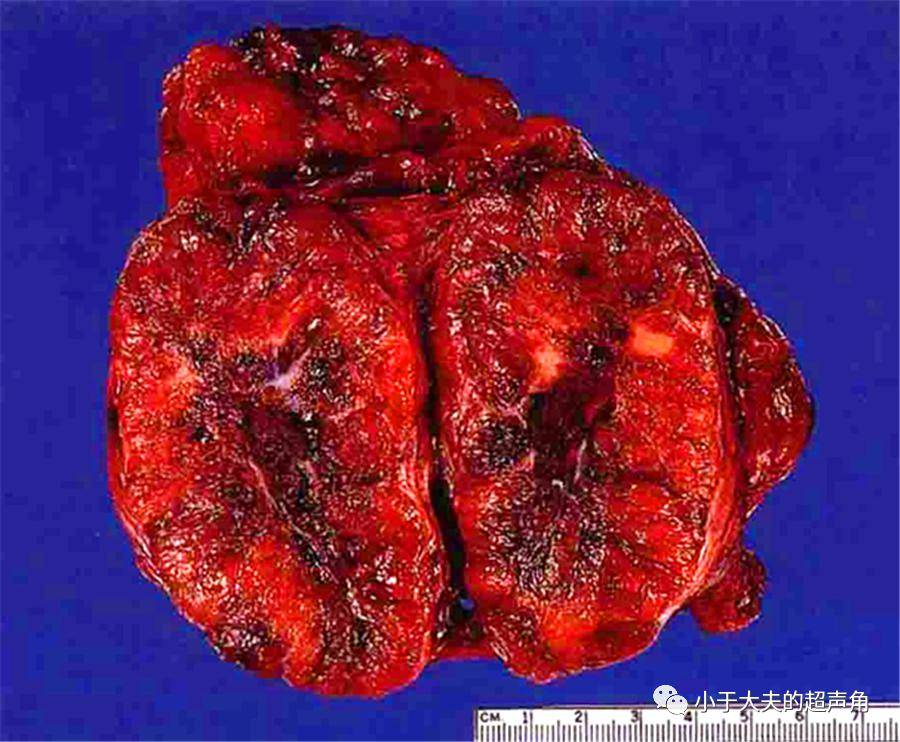 题外话:甲状腺hürthle细胞肿瘤的大体切面呈红褐色,比较有特点,有