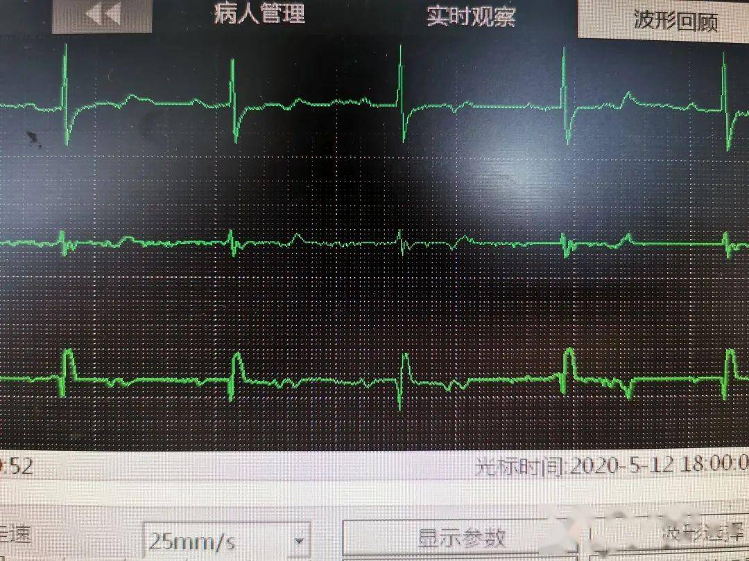 都是"三度房室传导阻滞"惹的