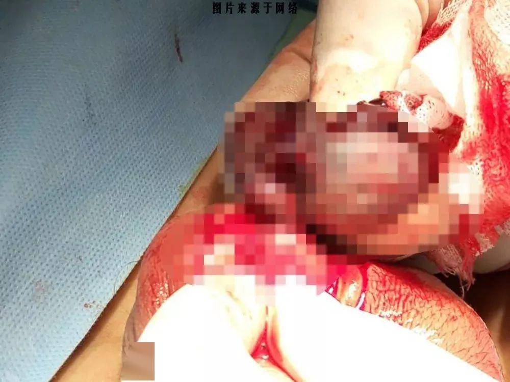 「睾丸」家有儿子一定要看又一起悲剧！男孩“蛋疼”1天致坏死