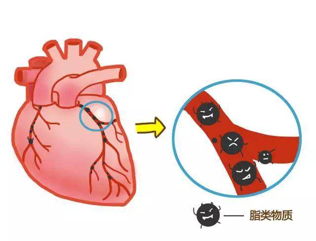 心脏跳得好好的, 怎么突然就"梗"了呢?_血管