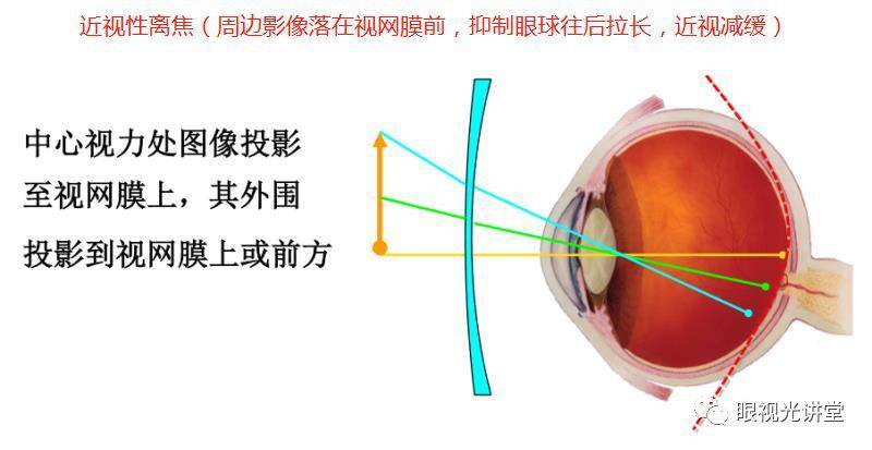 环焦镜片的原理_黄炳南 环焦镜片的定配原则与注意事项