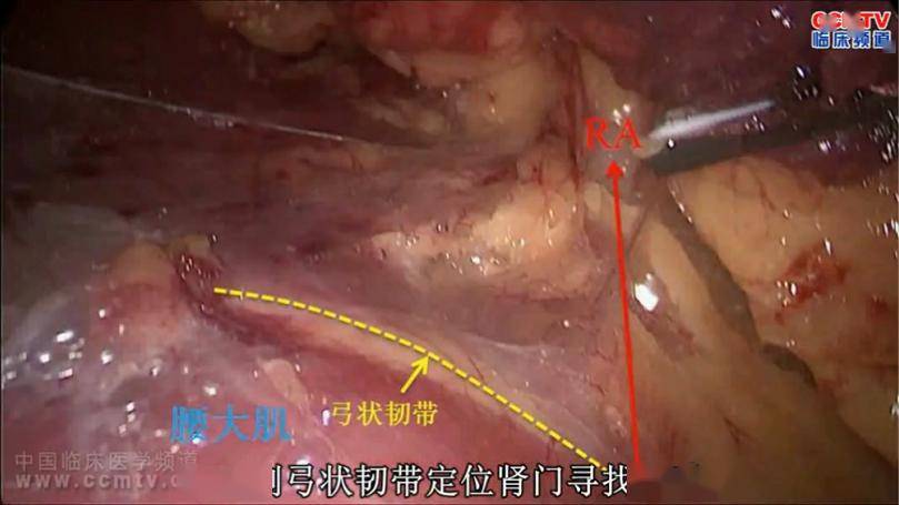 手术演示丨解剖性后腹腔镜根治性右肾切除术