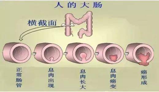 如何预防和治疗?_肠道