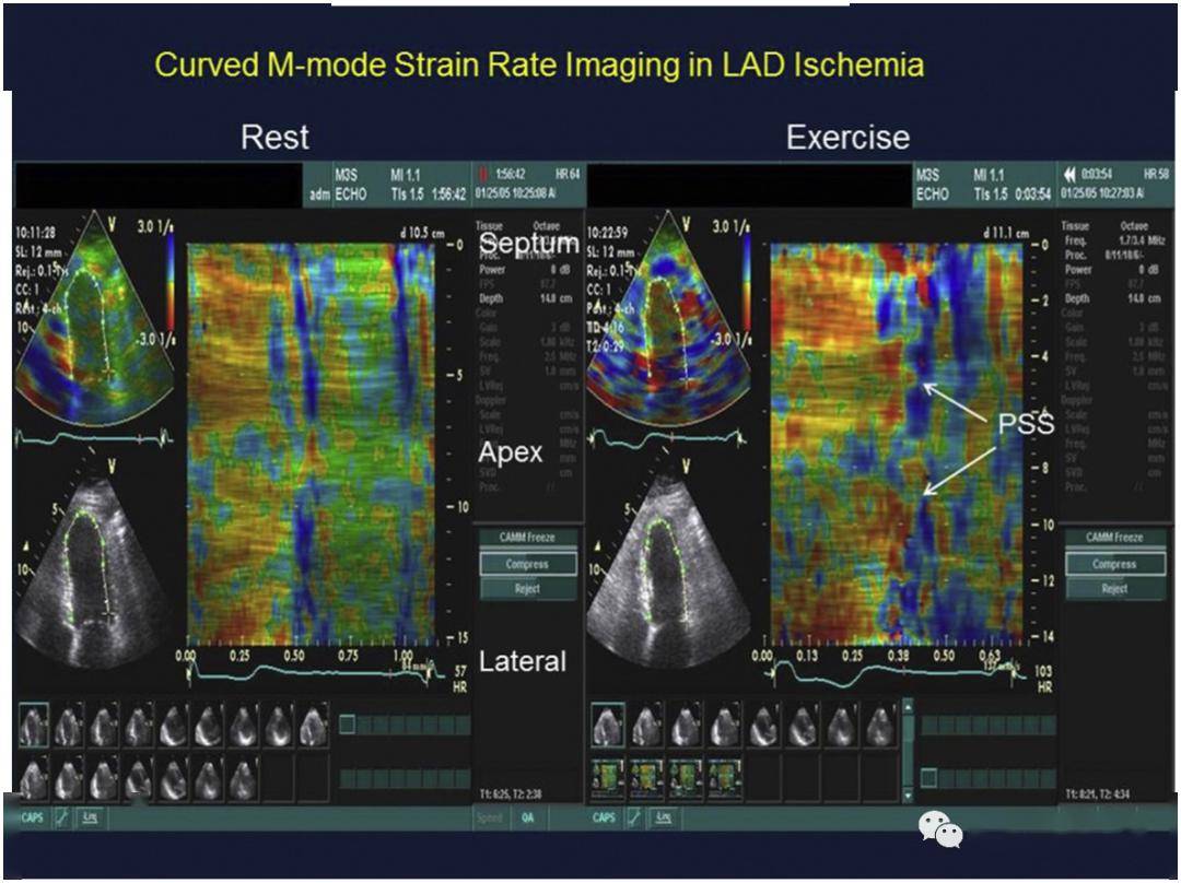 大知闲闲-wed:美国超声心动图学会:缺血性心脏病的负荷超声心动图表现