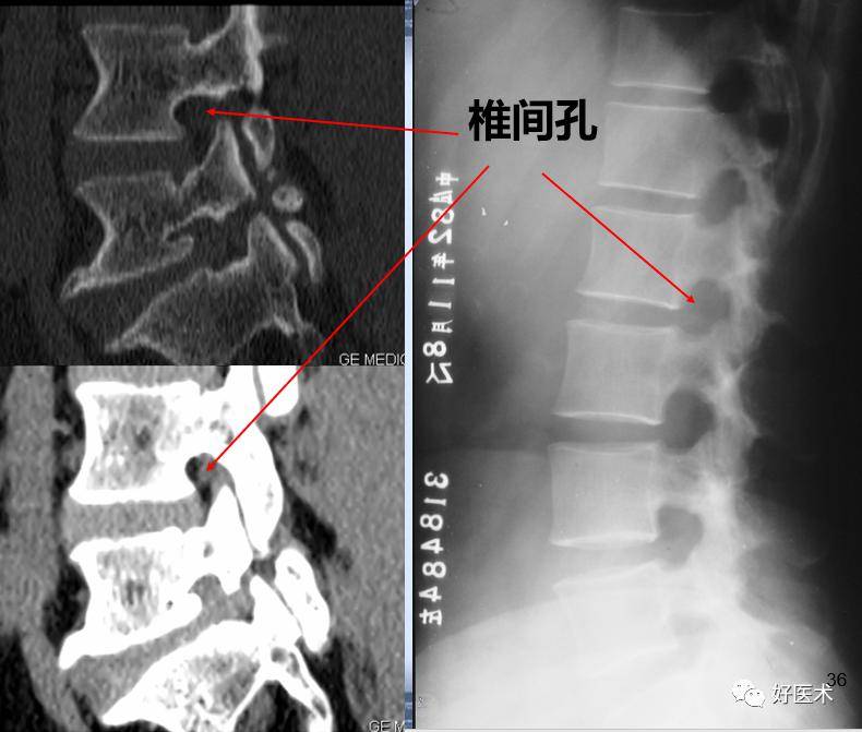 随着年龄的增长,后缘可变得平直; 正常l5-s1椎间盘的后缘较平直,并可