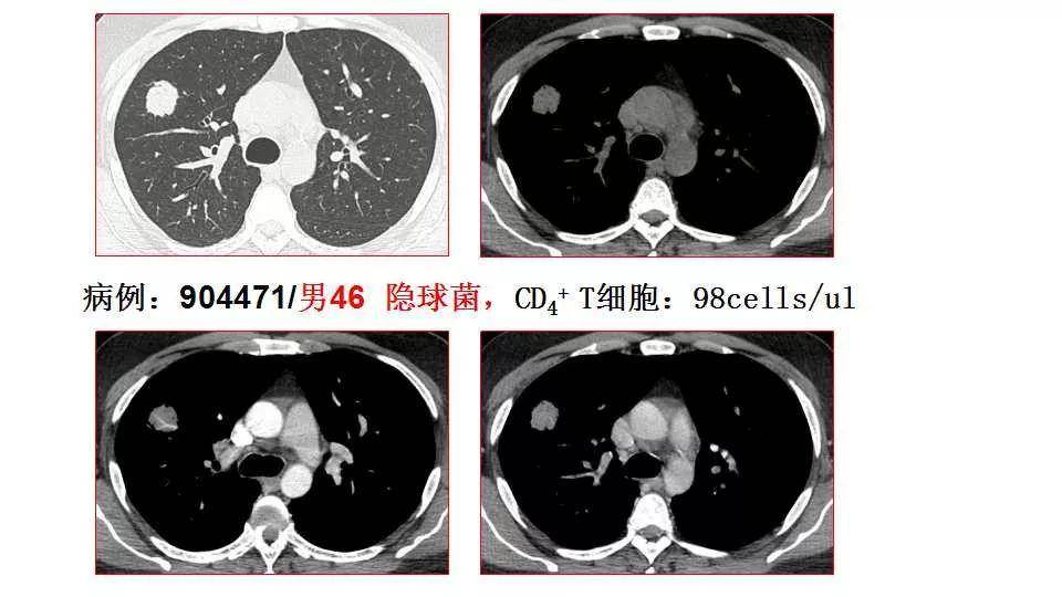 小结: 单发结节型与肺肿瘤鉴别的确存在难度 类似于免疫正常人群 a