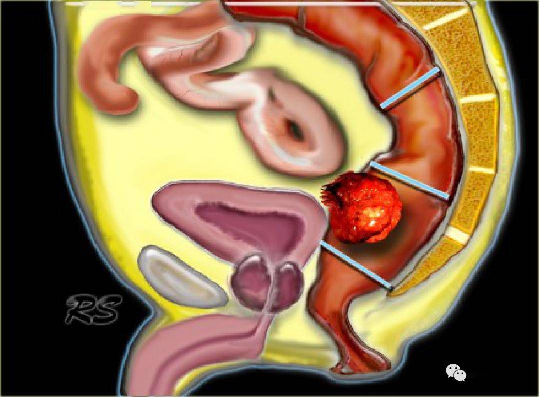 细意味着低位直肠癌更容易侵入周围的结构,外科手术根治肿瘤将会更难
