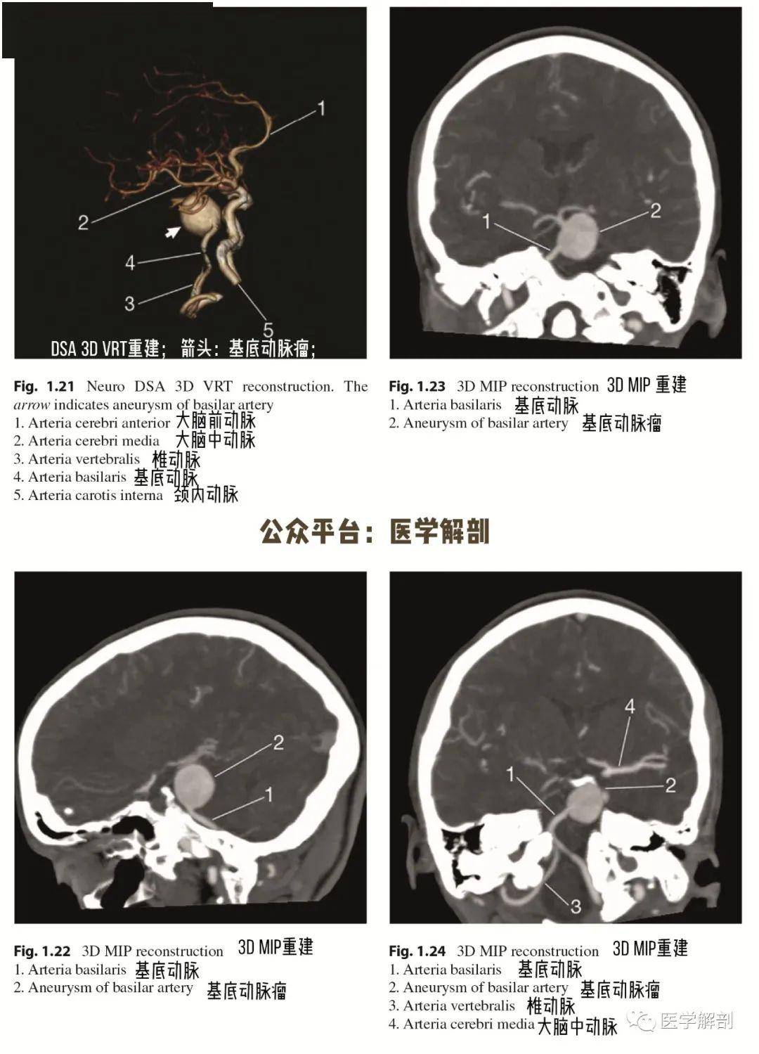 脑cta图谱基底动脉瘤