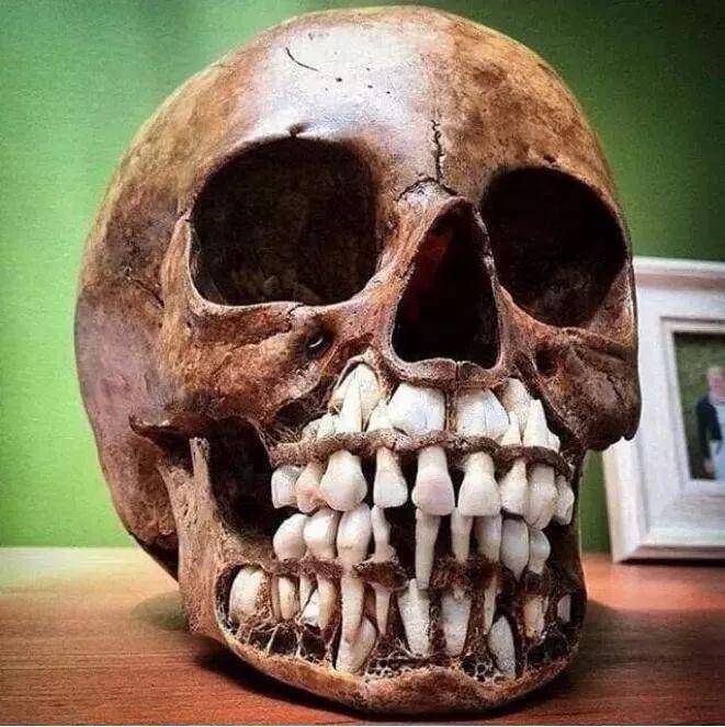 婴儿的头骨,他们的恒牙还在乳牙下方没长出来,看起来就有两排牙齿