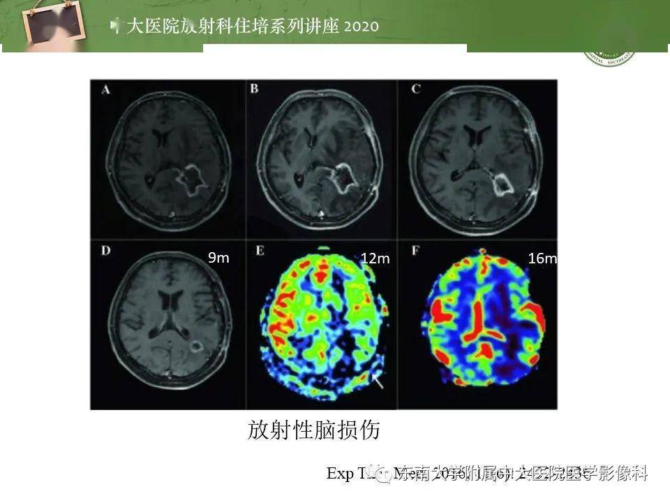 【中大放射住培系列讲座】胶质瘤复发与放射性脑损伤mr鉴别