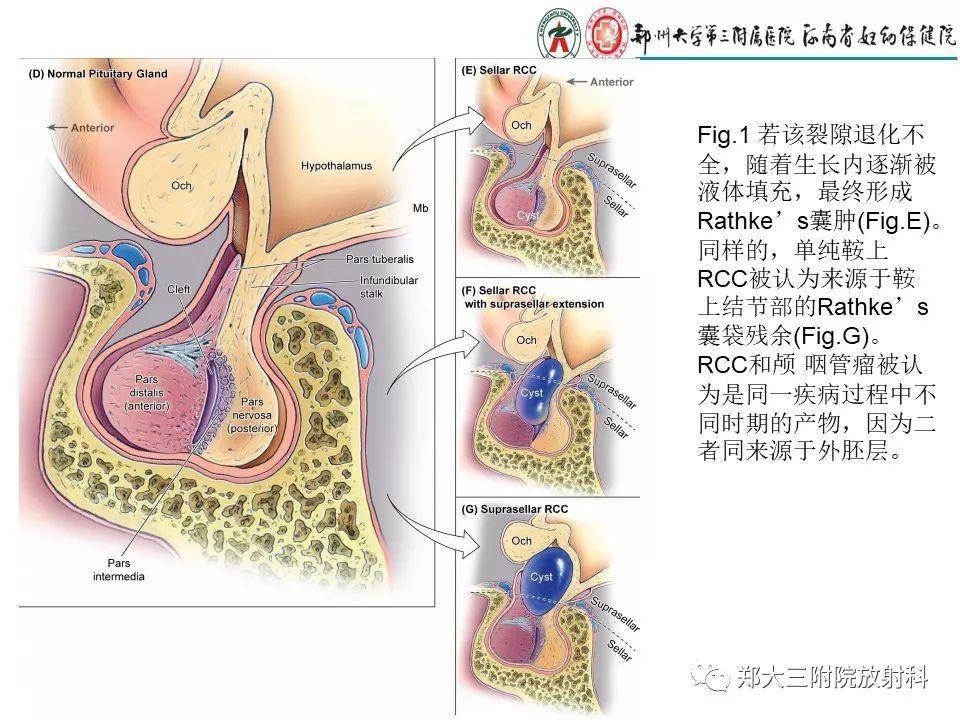 rathke "s 囊肿的影像诊断【zdzt055】