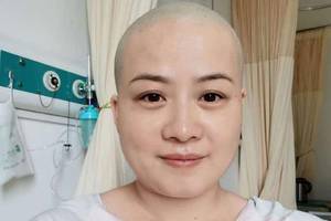 岳云鹏老婆为治疗再剃光头,眼含泪光难挡一脸大气面相