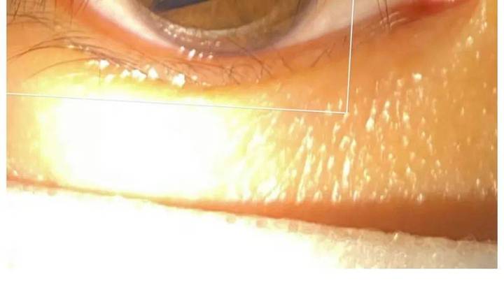 瞳孔变成三角形,你会害怕自己出现这种症状吗?
