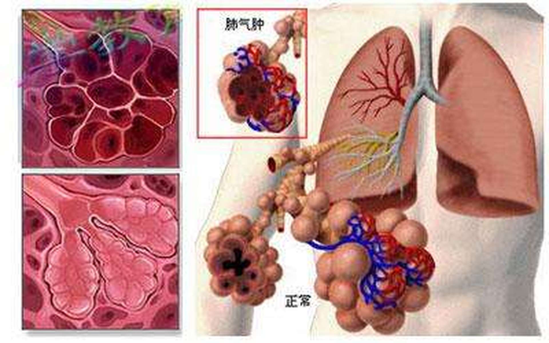 专家带你认识肺气肿逐渐加重的五个阶段