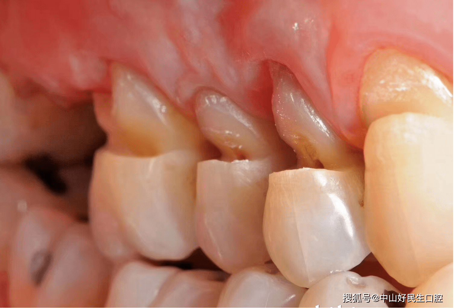 40岁男子看牙牙齿被医生拔光了