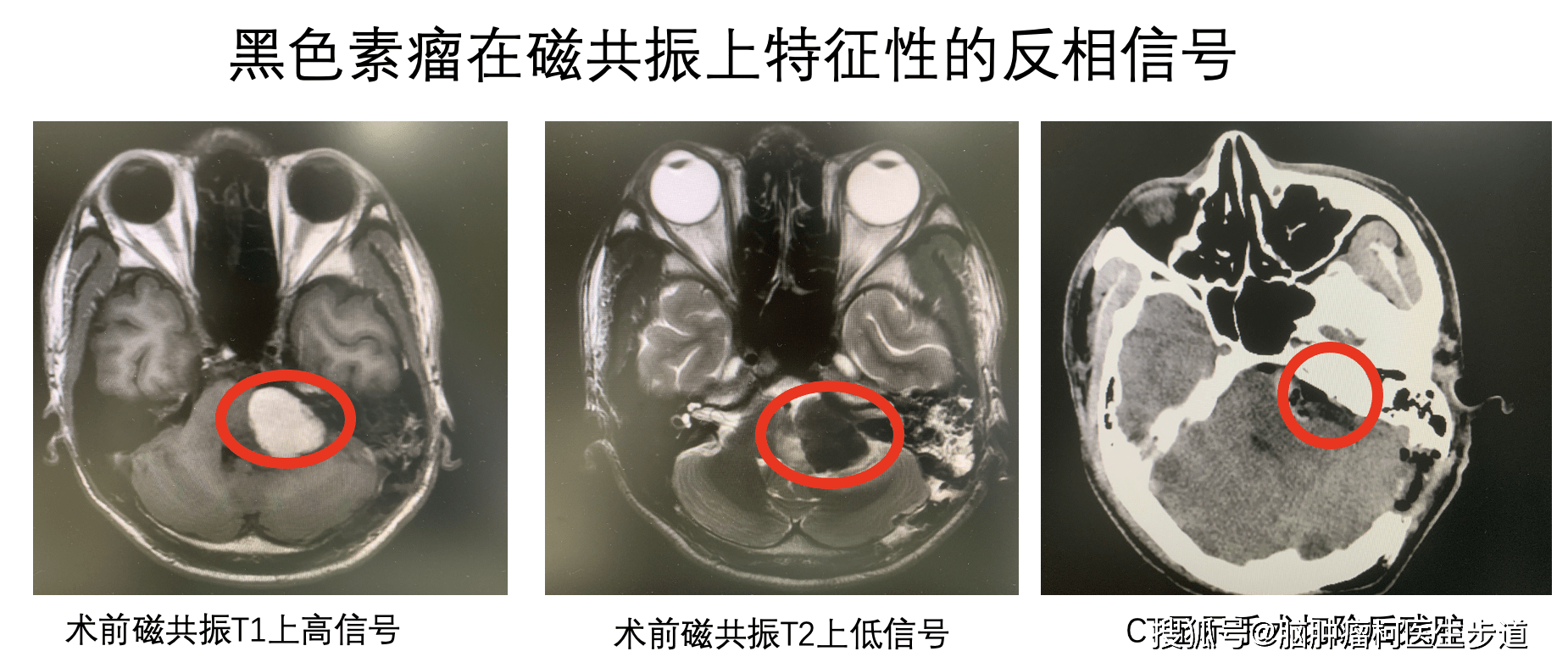 青年男子头痛难忍,中肿神外切除脑内黑炭样肿瘤