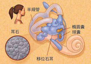 治疗 该病具有自限性,部分患者可自愈.治疗方法主要为耳石复位.