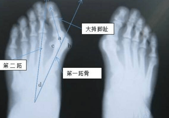 科普介绍什么是大脚骨牛江红带您了解