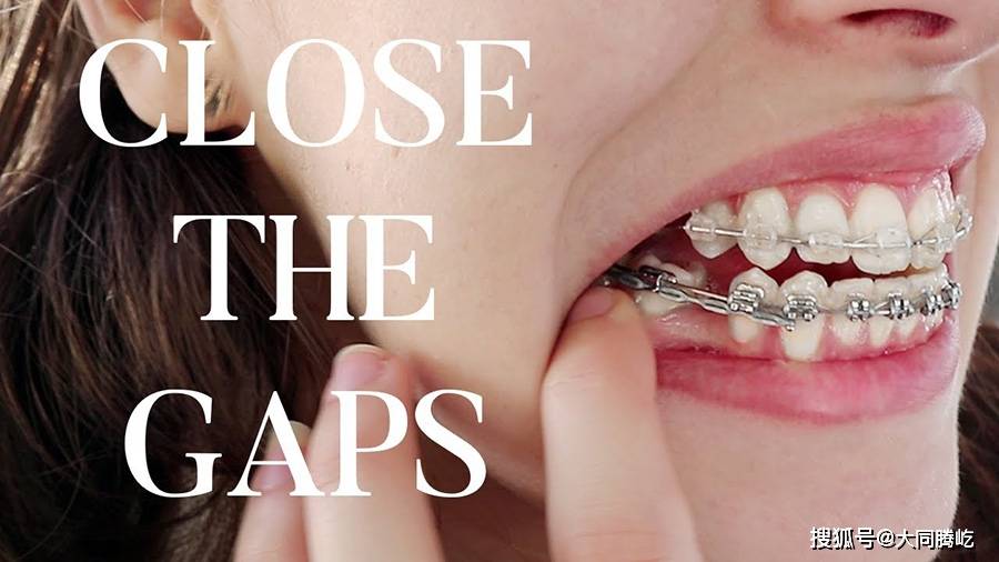 在用滑动法关闭拔牙间隙的过程中,如果四个切牙之间尚存在着散在间隙