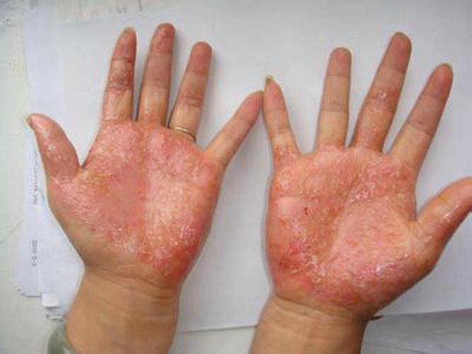汗疱疹和手部湿疹
