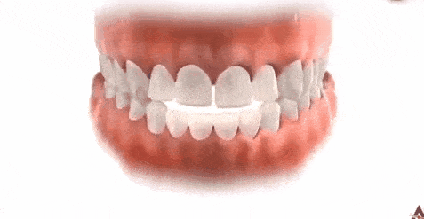 咬合更紧密:让牙齿紧扣在一起,接触面积达到最大,咀嚼效率达到最高.