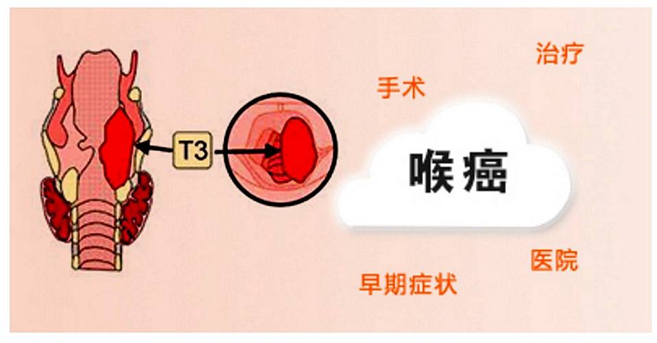 中医治喉肿瘤的临床意义及作用?成都中医肿瘤医院【段