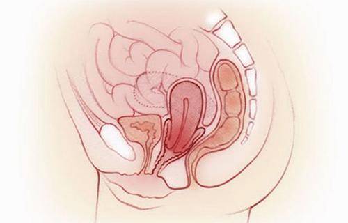 因此盆腔脏器脱垂有被分为: 前盆腔缺陷:包括膀胱及阴道前壁膨出以及