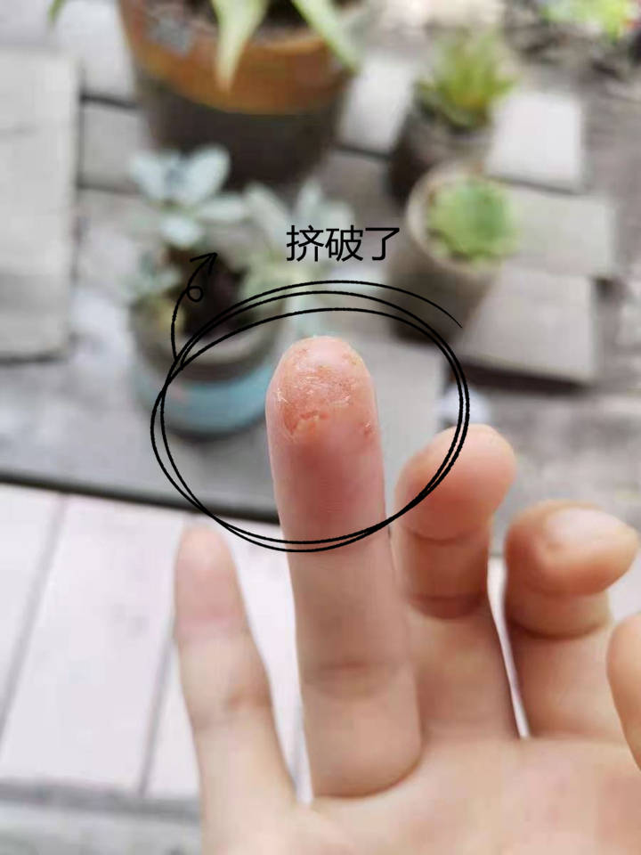 原创夏天手上起小水泡痒怎么办?2个习惯要当心