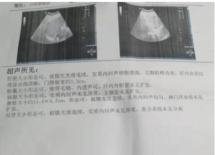 让我们跟广州和谐王远主任一起了解一下:如何知道自己有肝纤维化