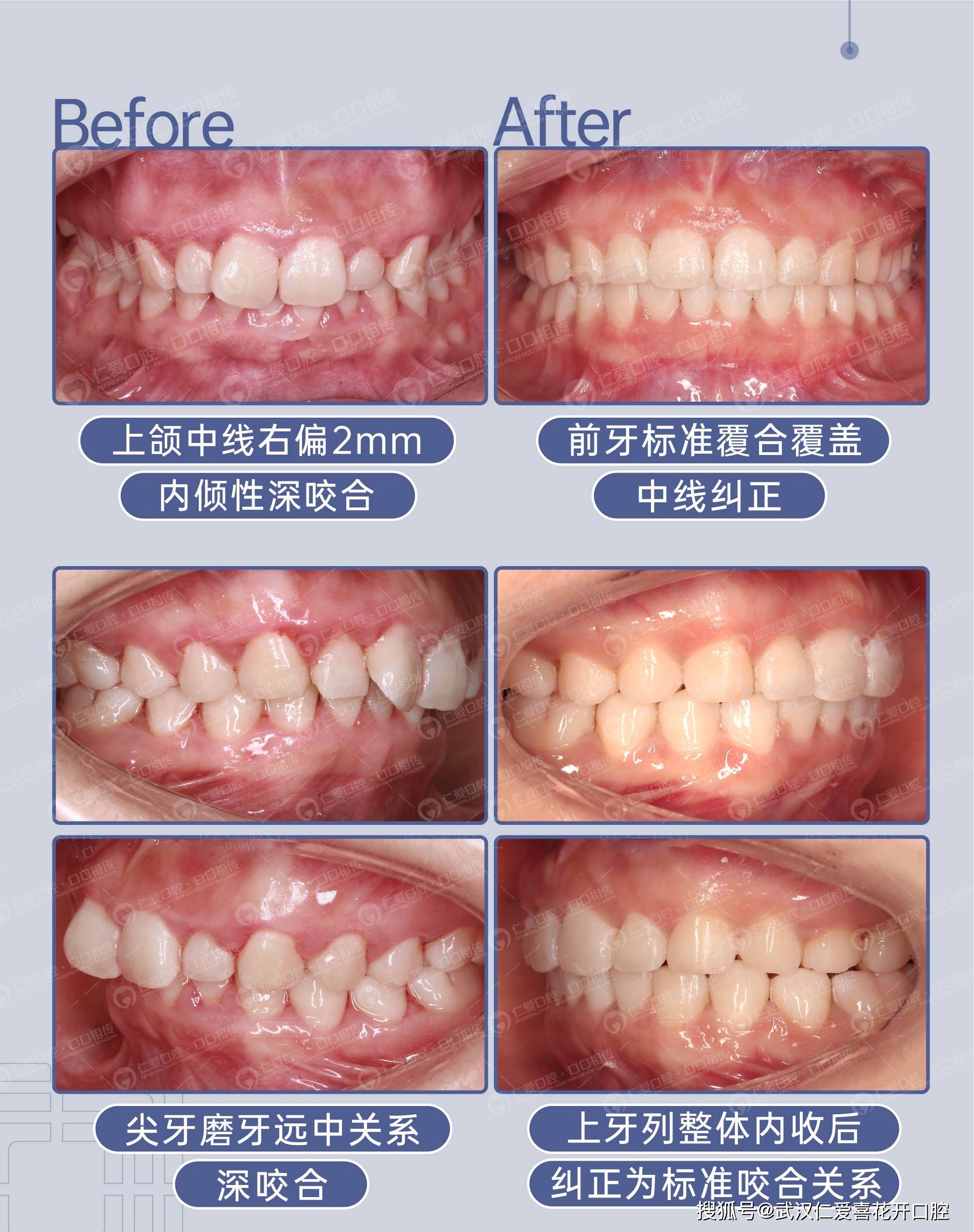 这么多种牙齿畸形,不矫正有什么影响吗?