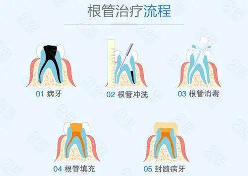 朗朗口腔:根管治疗 要知道的三件事!