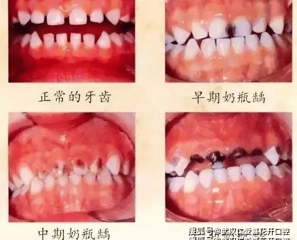 导致口腔内腐蚀牙体的细菌大量繁殖,久而久之牙齿脱钙,牙冠剥脱,就会