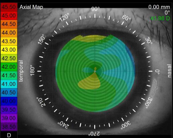 孩子裸眼视力1.0,戴眼镜可以看到1.2/1.5,算近视吗?