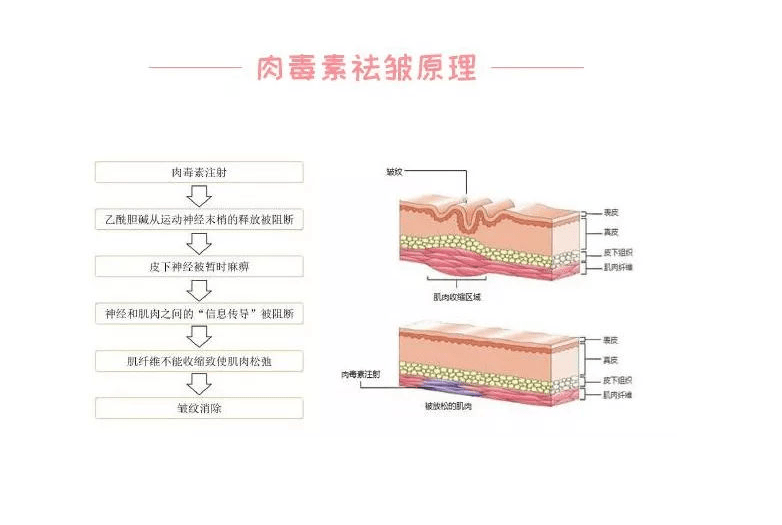 涂抹式肉毒素是智商税吗