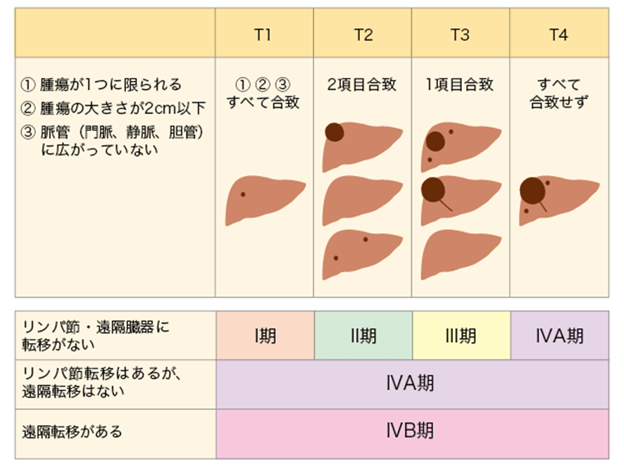 表1肝细胞癌的分期分类(日本肝癌研究会)肝细胞癌的分期取决于癌症的
