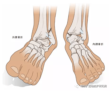 内踝骨折常伴有三角韧带损伤,也可能同时发生外踝或后踝骨折.