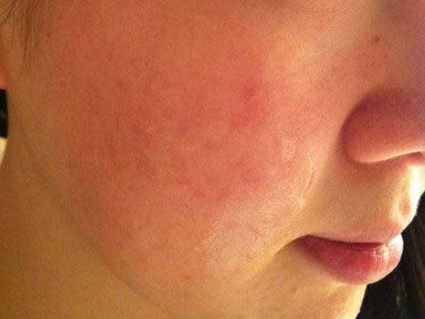 长春肤康医院浅谈:蚊虫叮咬可能引发荨麻疹?