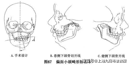 偏颌畸形是指上下颌侧方关系不调,牙中线不一致,颏部偏斜为主要临床