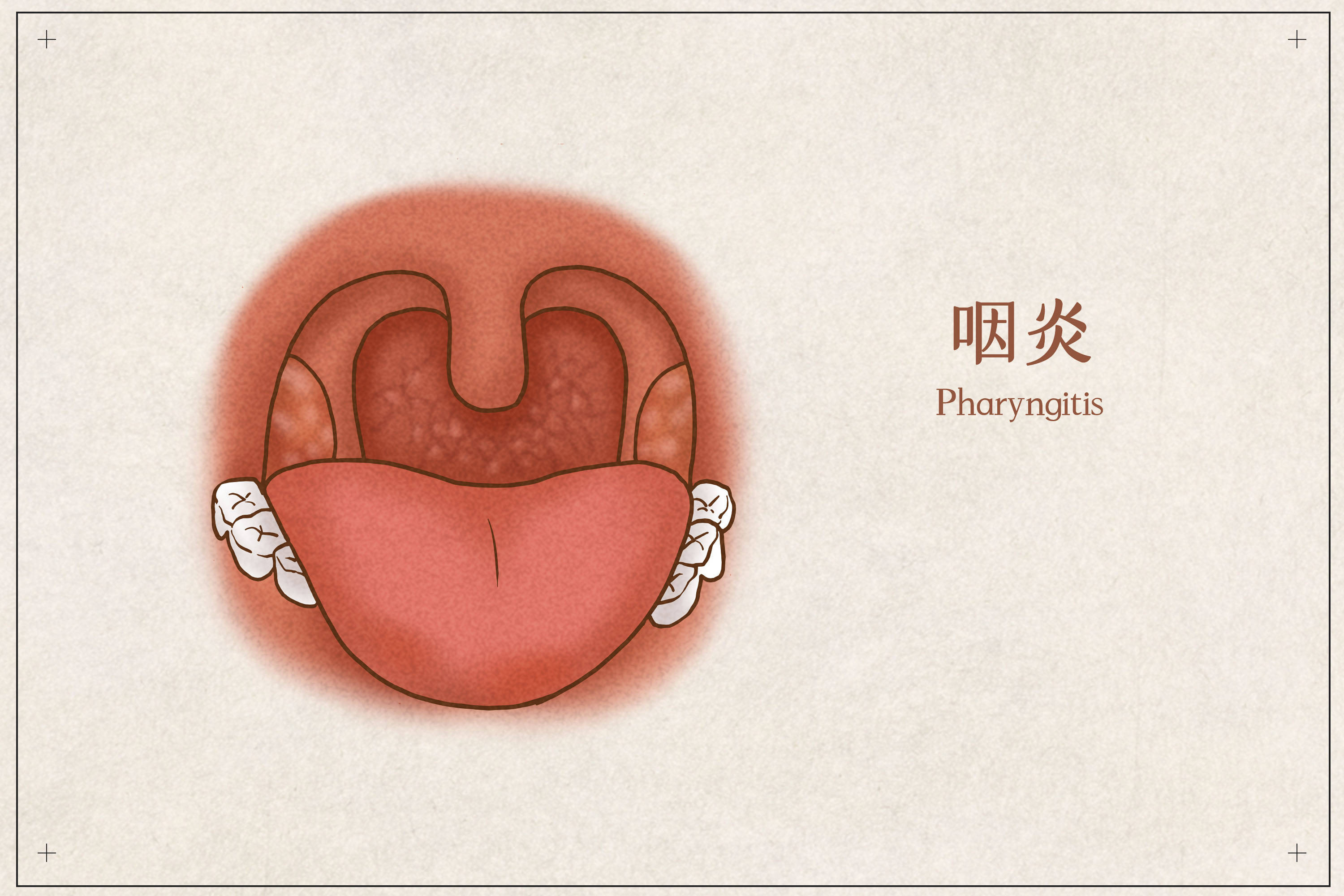 健康慢性咽炎你了解多少