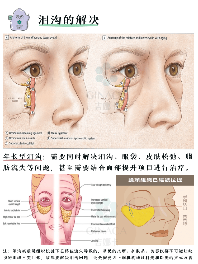 怎么去泪沟改善泪沟全攻略