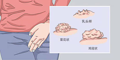 郑州合心医院尖锐湿疣常见症状