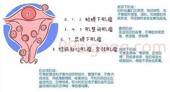 三,子宫肌瘤到底有哪些症状?