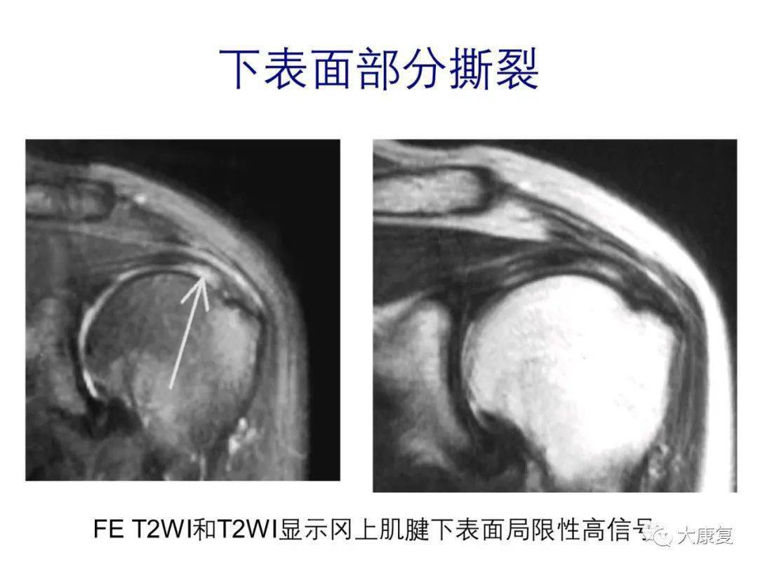 肩关节运动损伤影像诊断