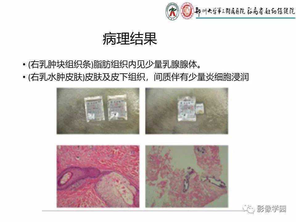 非哺乳期乳腺炎性病变与炎性乳癌影像诊断