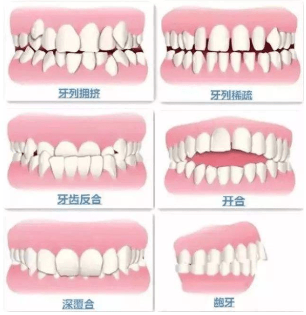 父母需知:小孩矫牙的最佳年龄 ?_牙齿