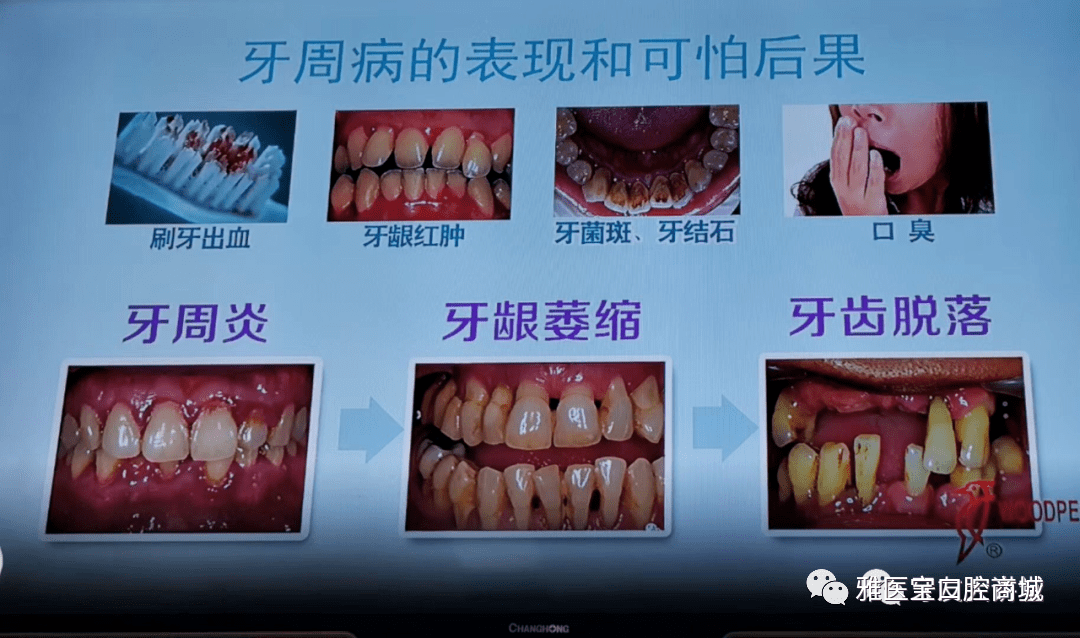 刷牙的时候会出血牙齿牙龈不痛也没有伤口这是什么原因呢