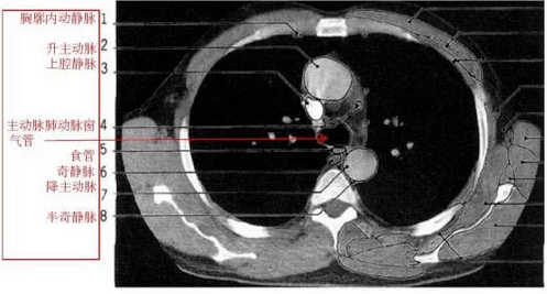 详尽的胸部ct影像示意图