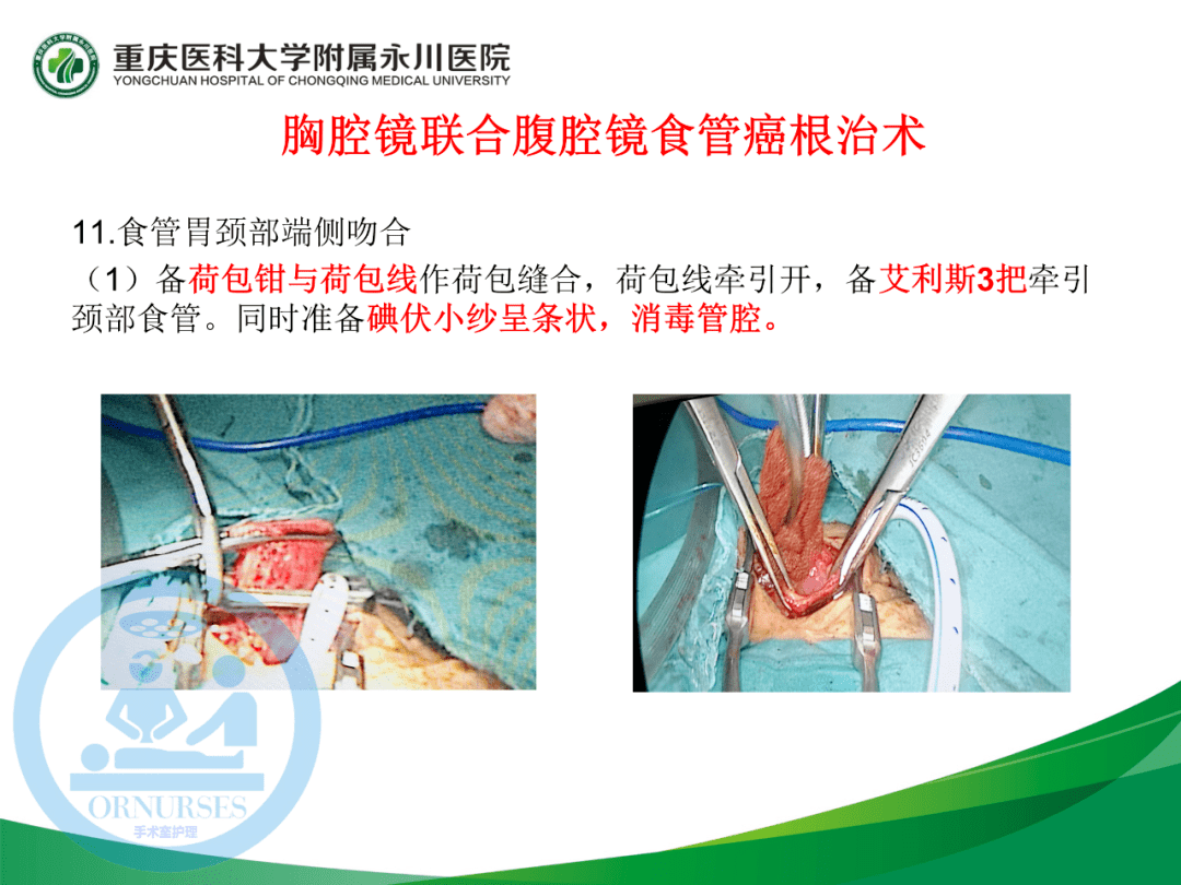 ppt胸腔镜联合腹腔镜食管癌根治术的手术配合