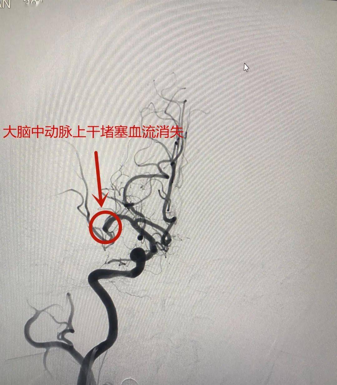 此时,核磁共振血管成像显示吴大爷右侧大脑中动脉上干堵塞,已导致